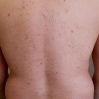 
	Malassezia folliculitis&nbsp;

	This man worked…