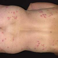 
	Pseudomonas folliculitis&nbsp;