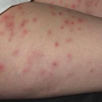 
	Pseudomonas folliculitis