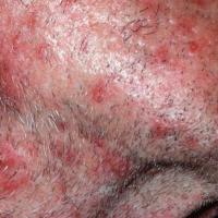 
	Sycosis barbae

	Lesions larger and more painful