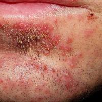 
	Folliculitis barbae

	Copied with kind…