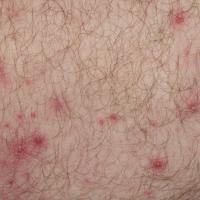 
	Folliculitis&nbsp;