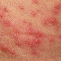 
	Folliculitis

	Copied with kind permission from…