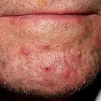 
	Folliculitis barbae