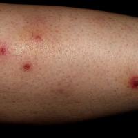 
	Folliculitis secondary to…