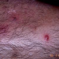 
	Folliculitis secondary to topical…