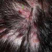 
	Folliculitis decalvans
Copied with kind…