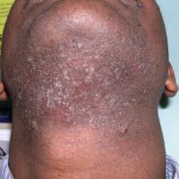
	Pseudofolliculitis