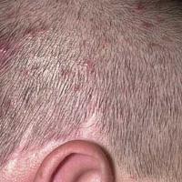 
	Scalp folliculitis