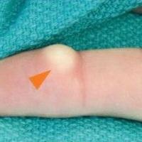 
	Epidermoid inclusion cyst 