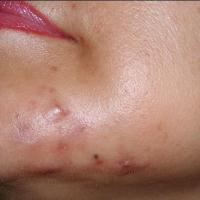
	Reaction to collagen, complicated by an…
