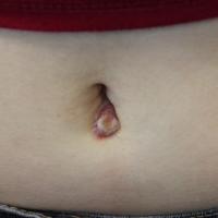 
	Retained Ethibond suture 
	
	This is a…