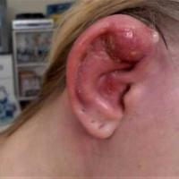 Reaction to ear piercing on the upper ear 