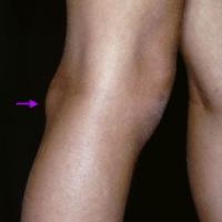 
	Baker's cyst