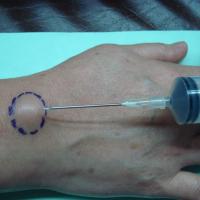 
	Aspiration of a ganglion

	The angle of entry…