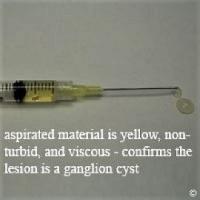 Aspirated cyst