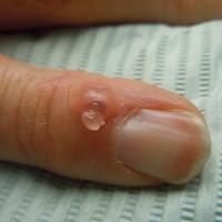 
	A myxoid cyst 

	The cyst has been punctured by…
