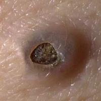 
	Close-up of giant comedone