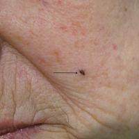 
	Giant comedone left cheek 