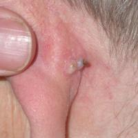 
	Comedone expressed by applying gentle pressure
