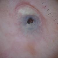 
	Dermoscopic appearance of a giant comedone