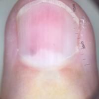 Dermoscopic appearance of previous figure
Copied…