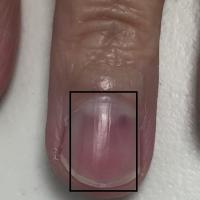 Glomus tumour
Copied with kind permission from…