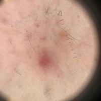 Dermoscopic appearance of previous image