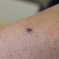 
	Glomus tumour on the forearm

	This patient…