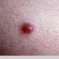 
	Glomus tumour