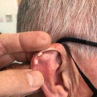 Gouty tophi ears&nbsp;
Copied with kind…