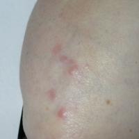 
	GA on the elbow

	Lesions are smooth and bumpy