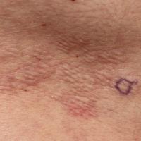 
	GA atypical

	This patient had more classical…