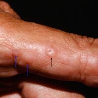 
	Perforating GA

	One lesion has perforated…