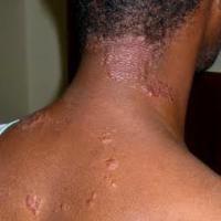 
	Sarcoidosis 