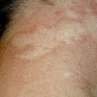 
	Actinic granuloma