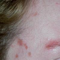 
	Granuloma faciale