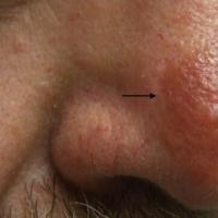 
	Granuloma faciale