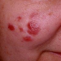 
	Granuloma faciale

	Copied with kind permission…