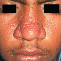 
	Granulosis rubra nasi