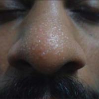 Granulosis rubra nasi
