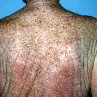 
	Grover's disease