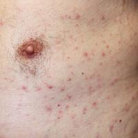 
	Grover's disease