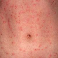 
	Guttate psoriasis
	
	More scale evident
