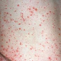 
	Guttate psoriasis - early
	
	Little scale is…