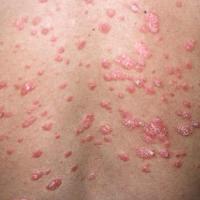 
	Guttate psoriasis
	
	Teardrop-like lesions with…