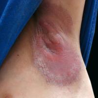 
	Hailey-Hailey disease