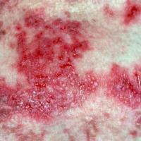 
	Hailey-Hailey disease