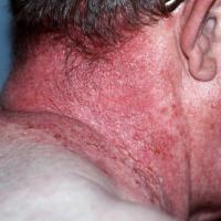 
	Hailey-Hailey disease