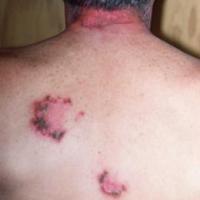
	Hailey-Hailey disease